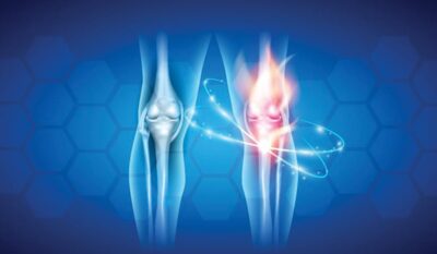 Osteoarthritis Physiotherapy: Managing Pain and Improving Mobility