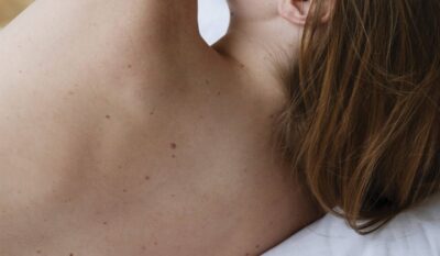 What are moles – and when and how are they treated?