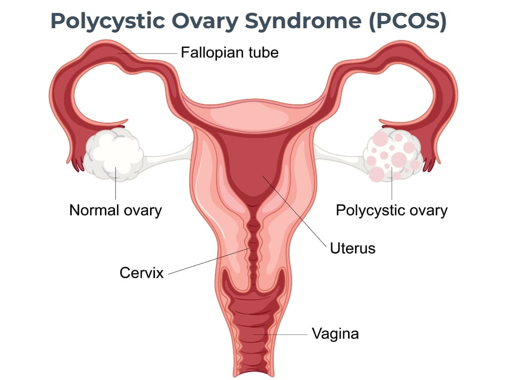 Polycystic Ovary Syndrome