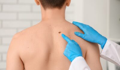 The Importance of Getting Suspicious-Looking Moles Checked