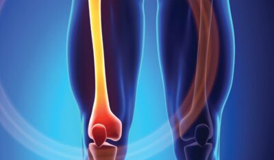 Bone Health Blood Test