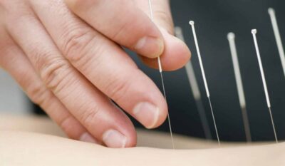 Acupuncture for Sports and Muscle Injuries