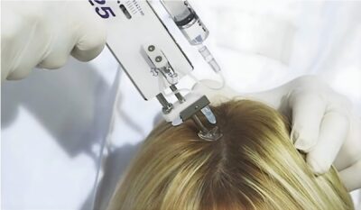 Advanced MCT-Grade Platelet-Rich Plasma (PRP) Therapy for Hair Loss