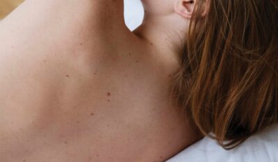 Cryotherapy Treatment