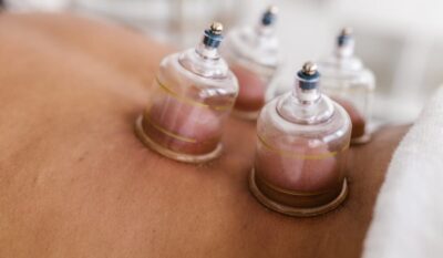 Dry Cupping