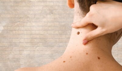 Understanding Seborrheic Keratosis: Causes, Symptoms, and Treatment Options at The Health Suite