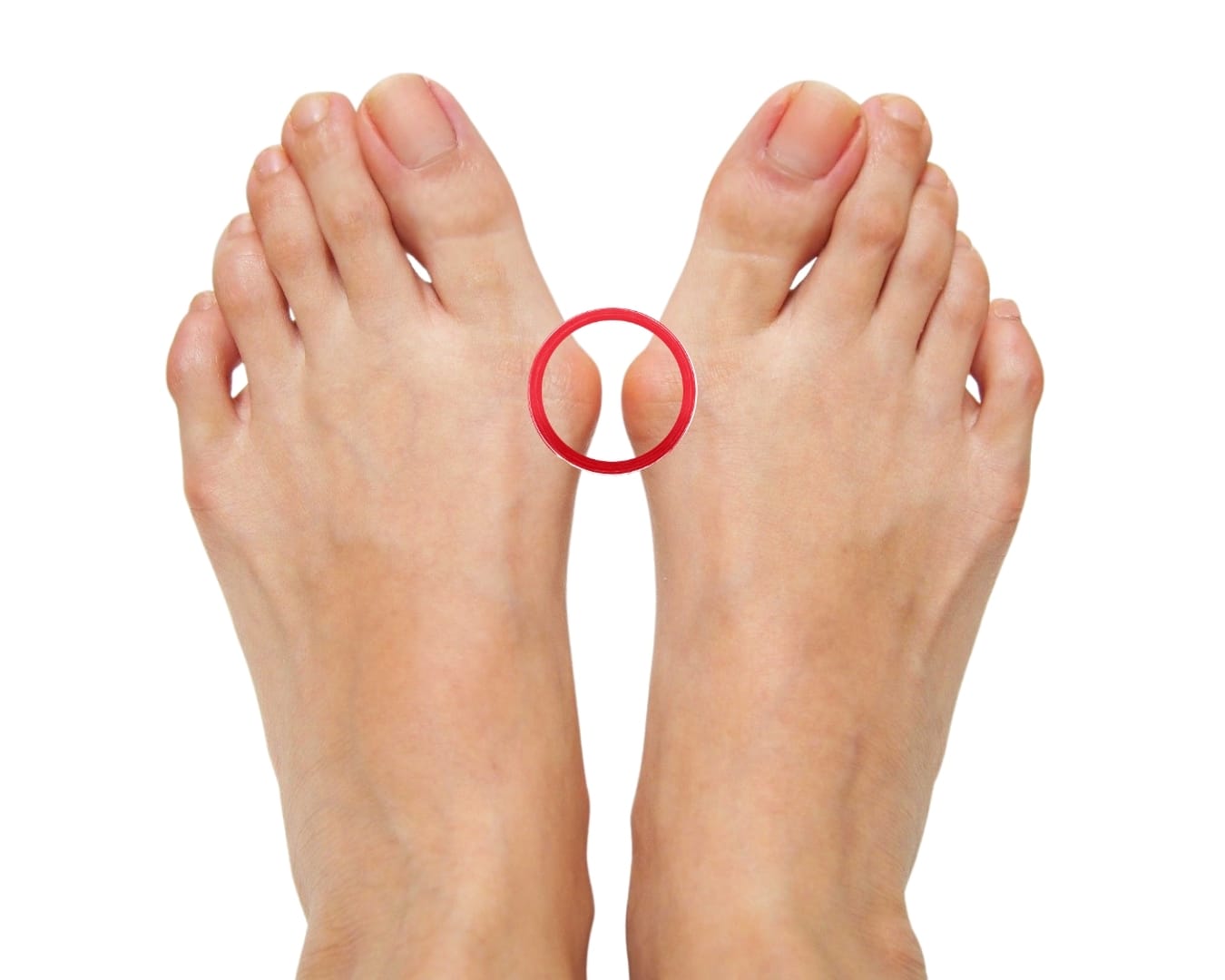 Bunions