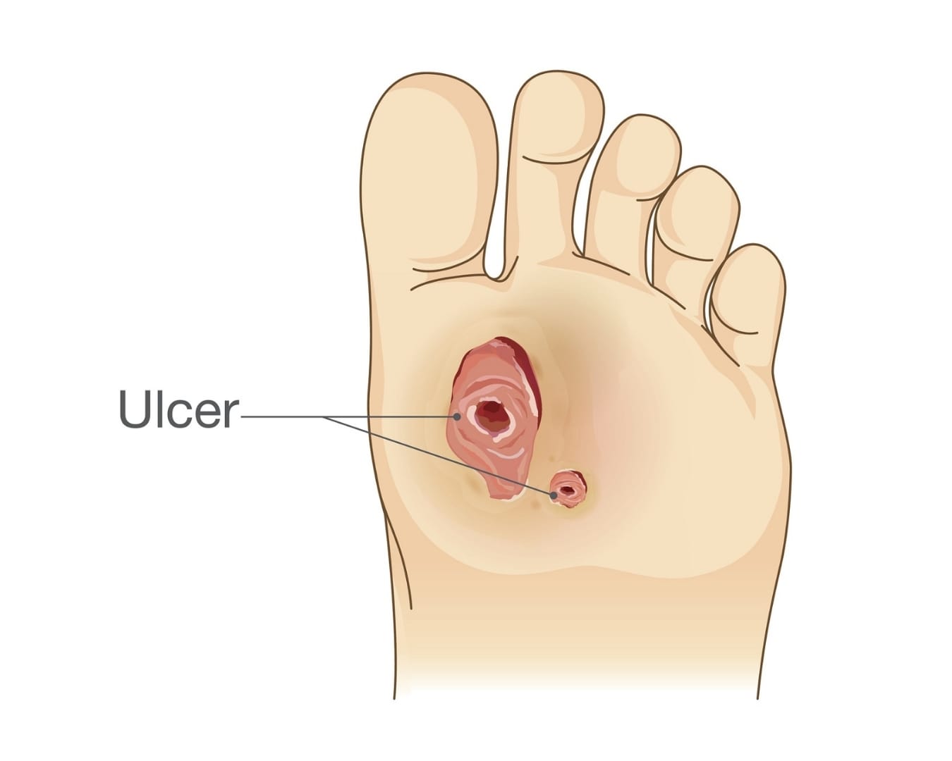 Diabetic Foot