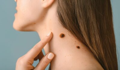 Mole Mapping
