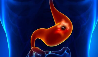 Neuro-Gastroenterology