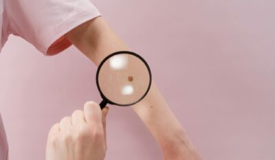 Skin Lesion Photography and Mole Check