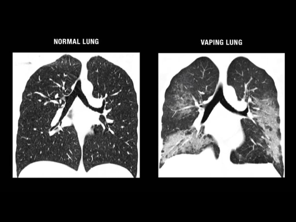 lungs of a smoker and non smoker (1)