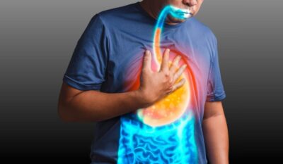 Acid Reflux: A Nutritionist’s Guide to Managing GERD (GORD)
