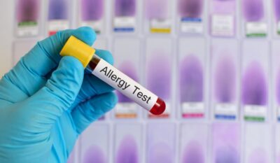 ALEX² Molecular Allergy Blood Testing