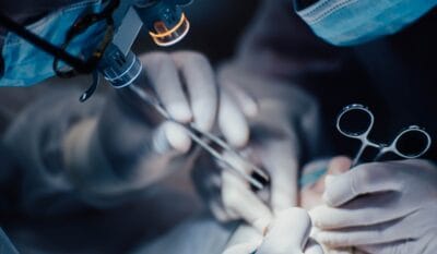 Pilonidal Sinus Laser Treatment