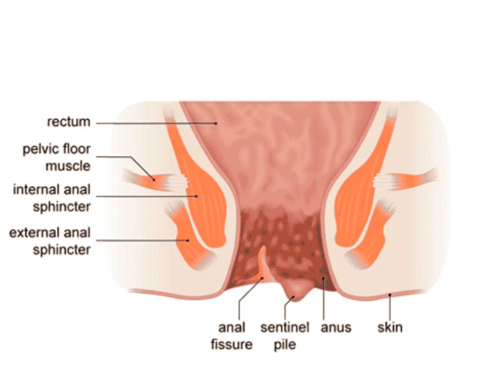 Anal Fissures
