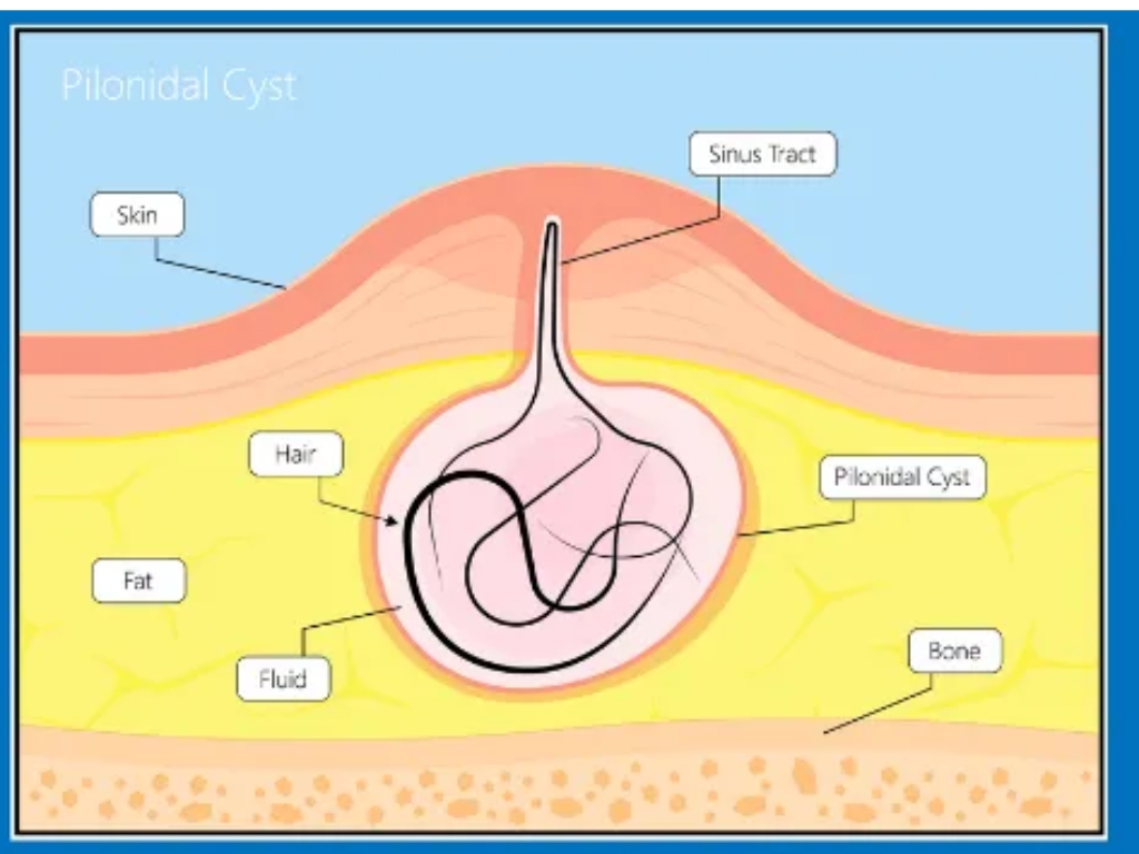 Pilonidal Sinus