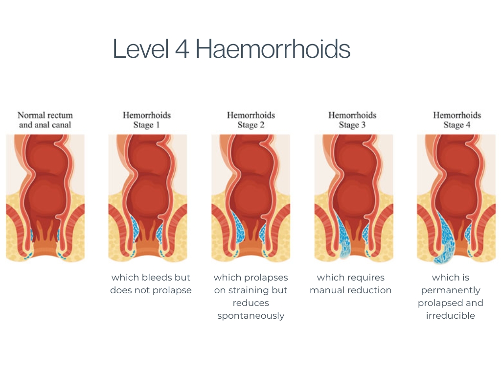 level 4 haemorrhoids
