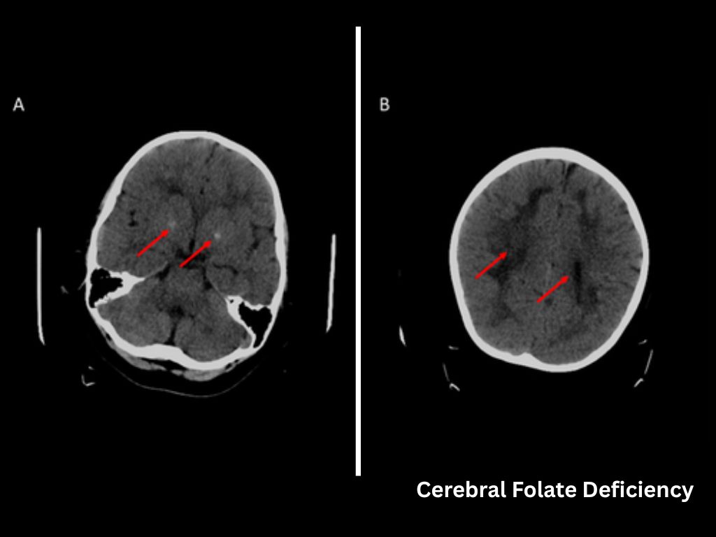 Cerebral Folate Deficiency