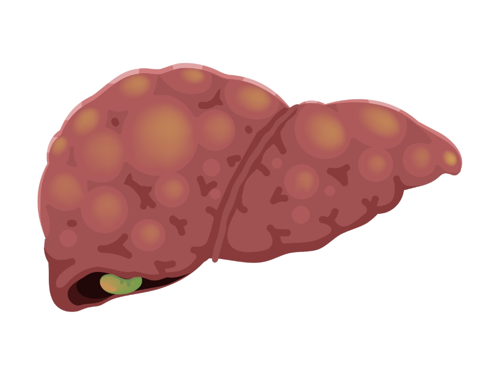 What Is Fatty Liver Disease