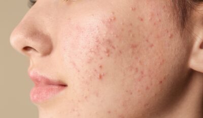 Acne-Prone & Congested Skin Treatment