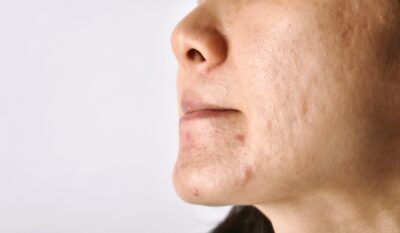 Acne Scarring Treatment