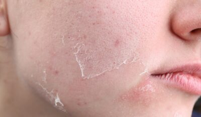 Dull, Tired & Dehydrated Skin Treatment
