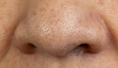 Enlarged Pores & Rough Skin Texture Treatment