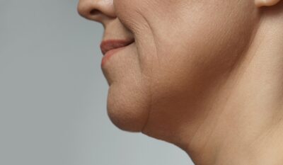 Fine Lines & Early Skin Ageing Treatment