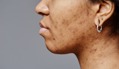 Pigmentation & Uneven Skin Tone Treatment