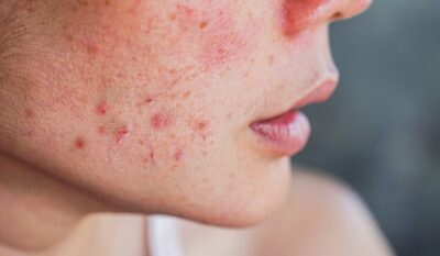 Redness & Sensitive Skin Treatment