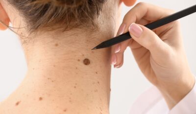 Skin Tag, Mole & Benign Lesion Removal
